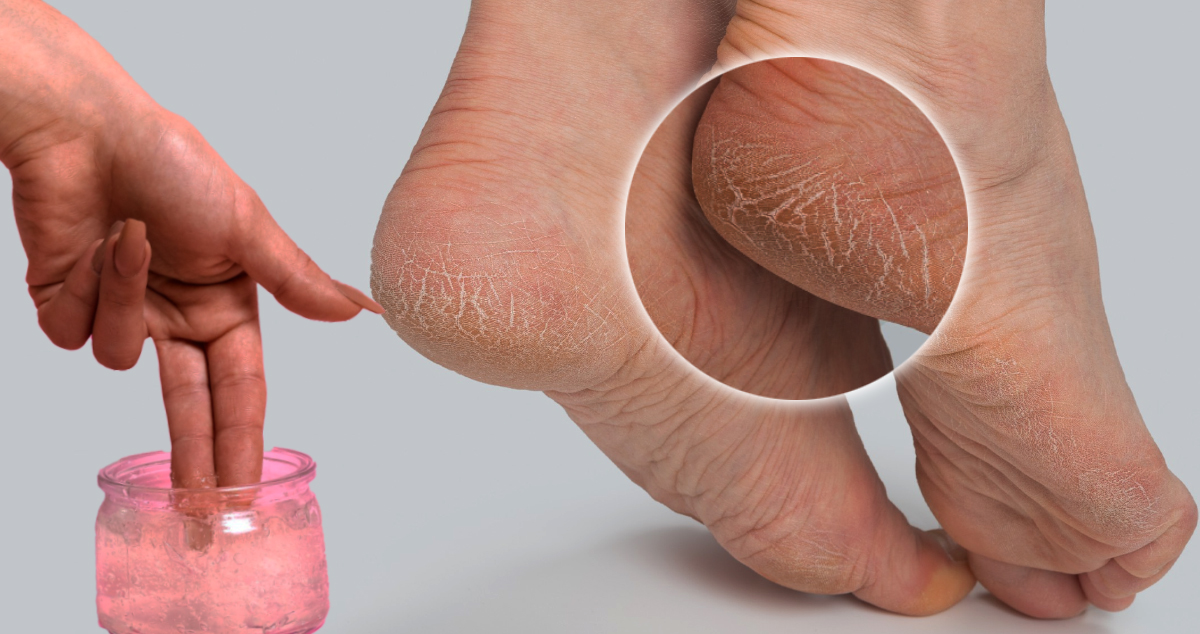 Cum Tratezi CĂLCÂIELE Crăpate ACASĂ Fără Chimicale - Iată sfaturile dermatologilor