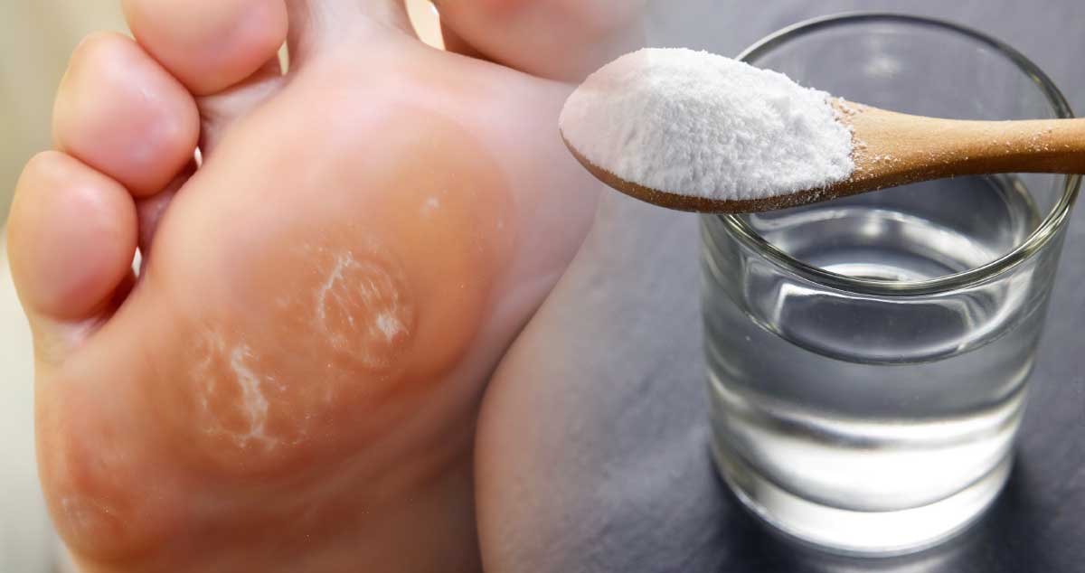 Scapă de BĂTĂTURI fără să mergi la medic / Remedii ACASĂ care te scap rapid de bătături