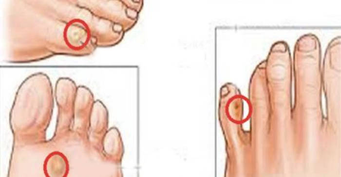 Încearcă aceste trucuri simple și scapă de calusuri și bătături