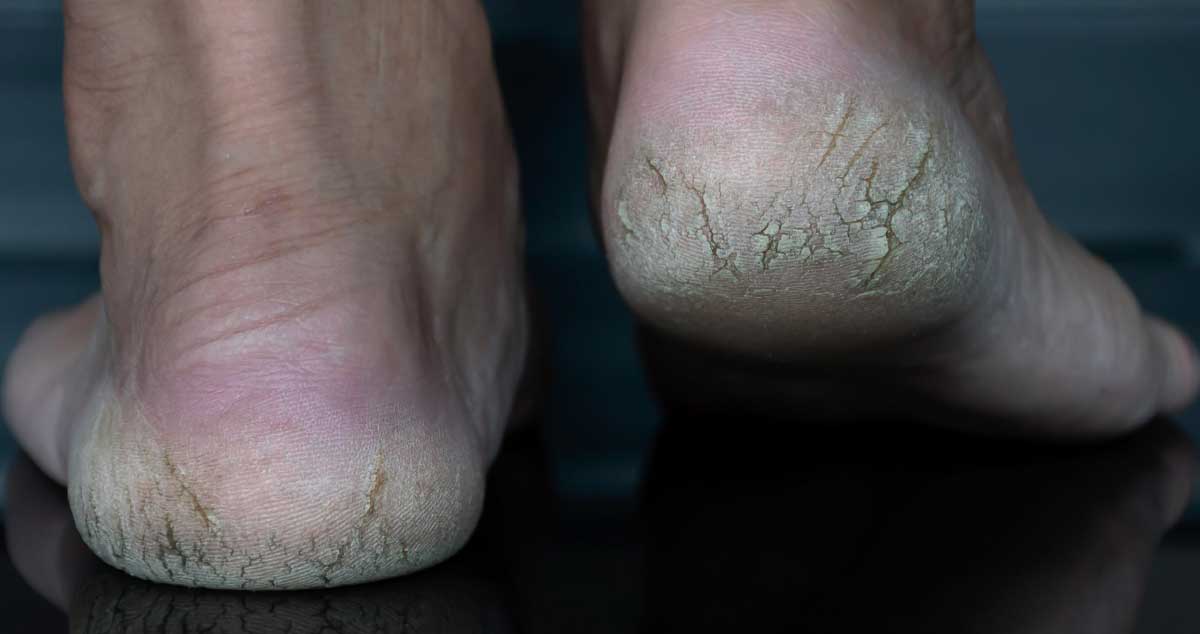 Picioare și Călcâie CRĂPATE  - Remedii Pentru Naturiste care FUNCȚIONEAZĂ