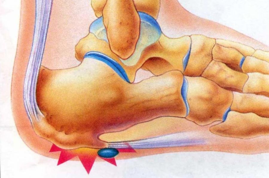 Remedii banale dar foarte eficiente care te scapă de pintenii calcaneeni (ciocuri)