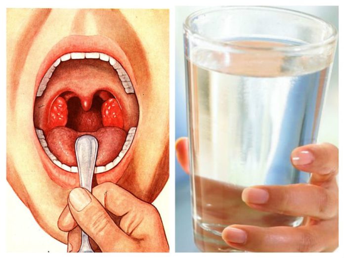 Gargara cu apă sărată - Scapi rapid de durerea în gât