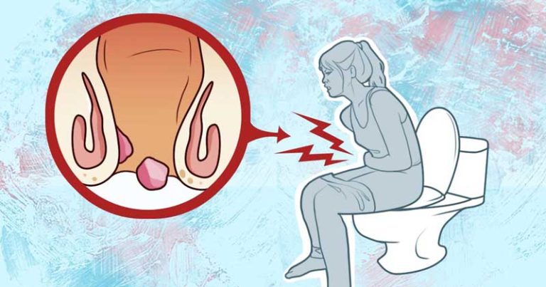 6 remedii din casă care te pot ajuta sa scapi de hemoroizi