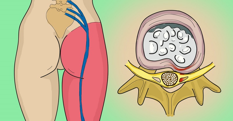 10 Remedii pentru durerile nervului sciatic - Remedii eficiente și sfaturi