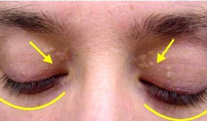 Dacă observi aceste pete galbene pe pleoape