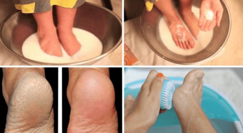 Iată cum poți scăpa de picioarele crăpate și urâte