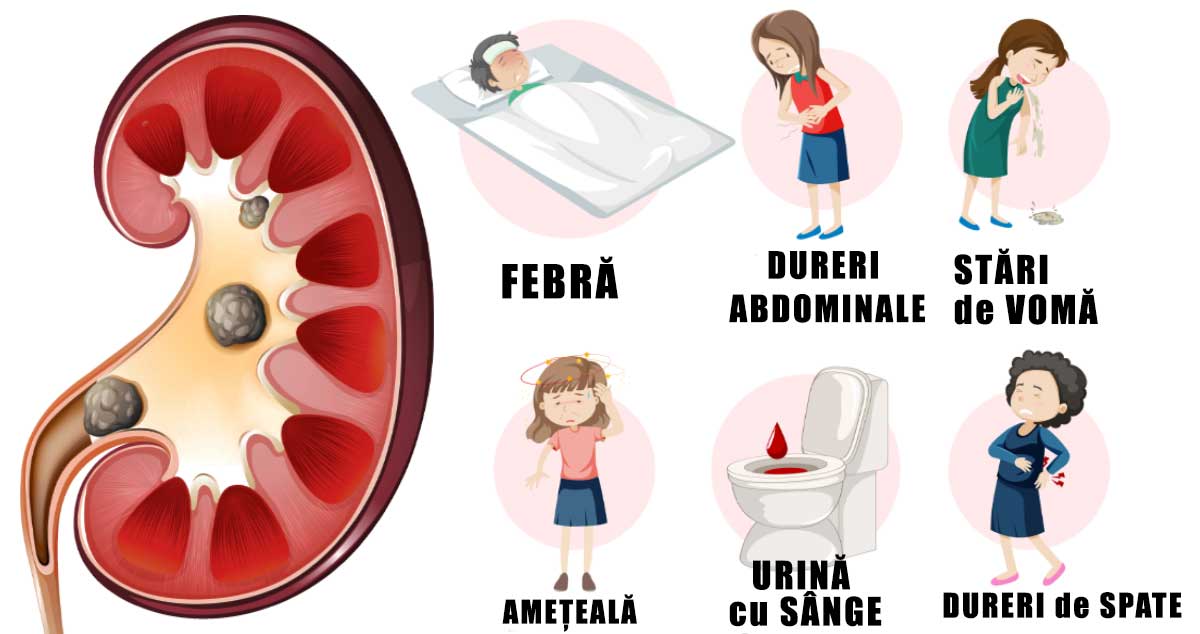 Primele SIMPTOME când ai PIETRE la RINICHI - Vezi care sunt și ce trebuie să faci!